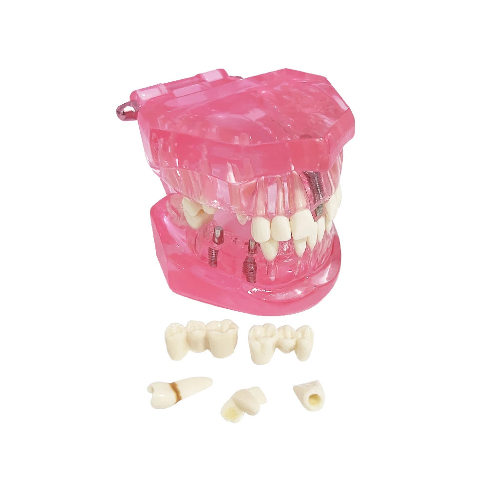 4D Human Teeth Model Dental Transparent Disease Removable Teeth Model With Restoration Bridge for Dentist Student Practice Teaching Study Medical