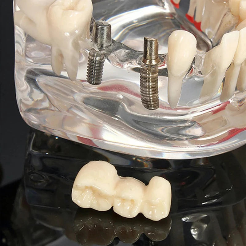 4D Human Teeth Model  Dental Diseases Tooth Model Repairable Resin Models Of Diseased Teeth For Teaching And Research