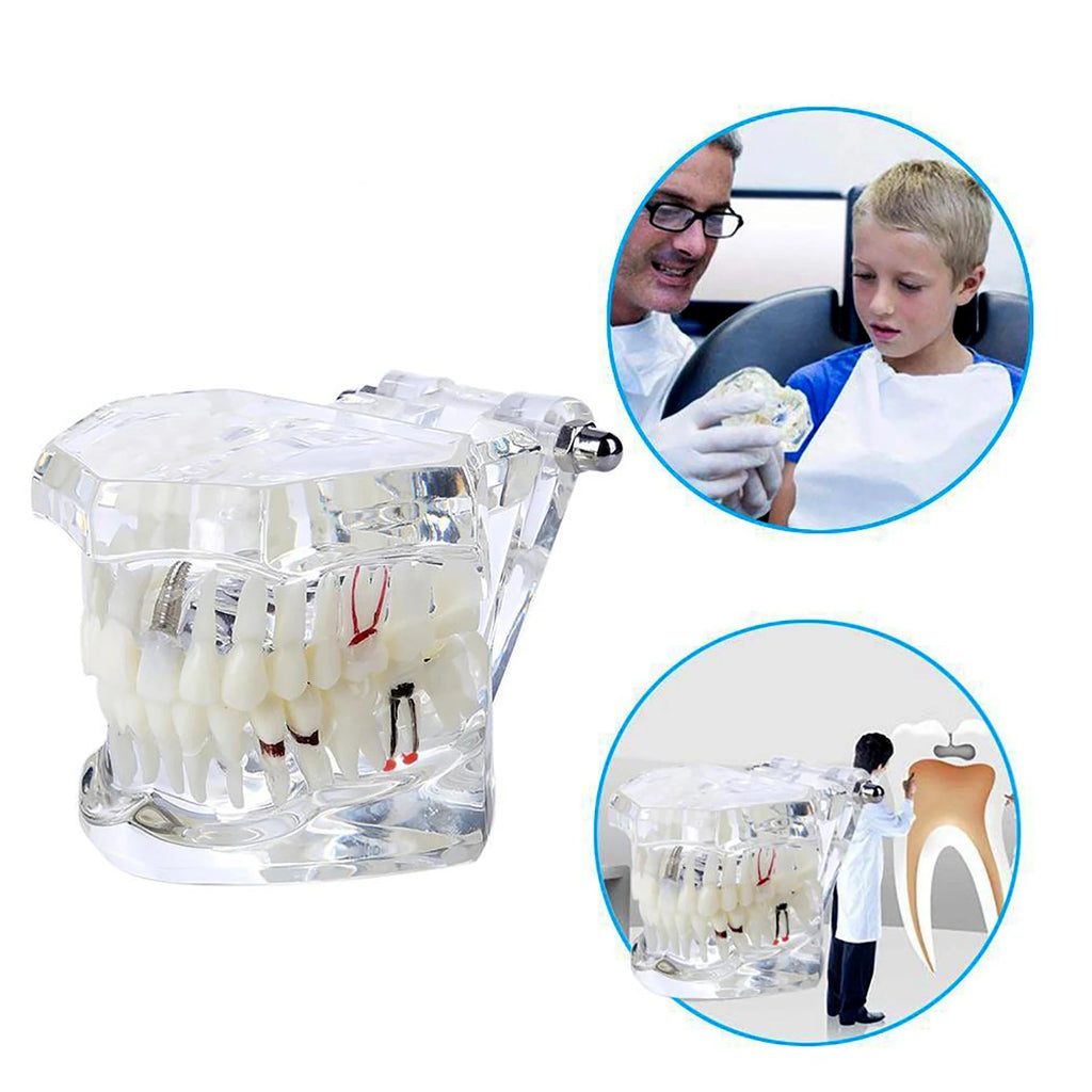 4D Human Teeth Model Dental laboratory Implant Disease Repairable Resin Models Dentist Dental Student Learning Teaching Research Communication