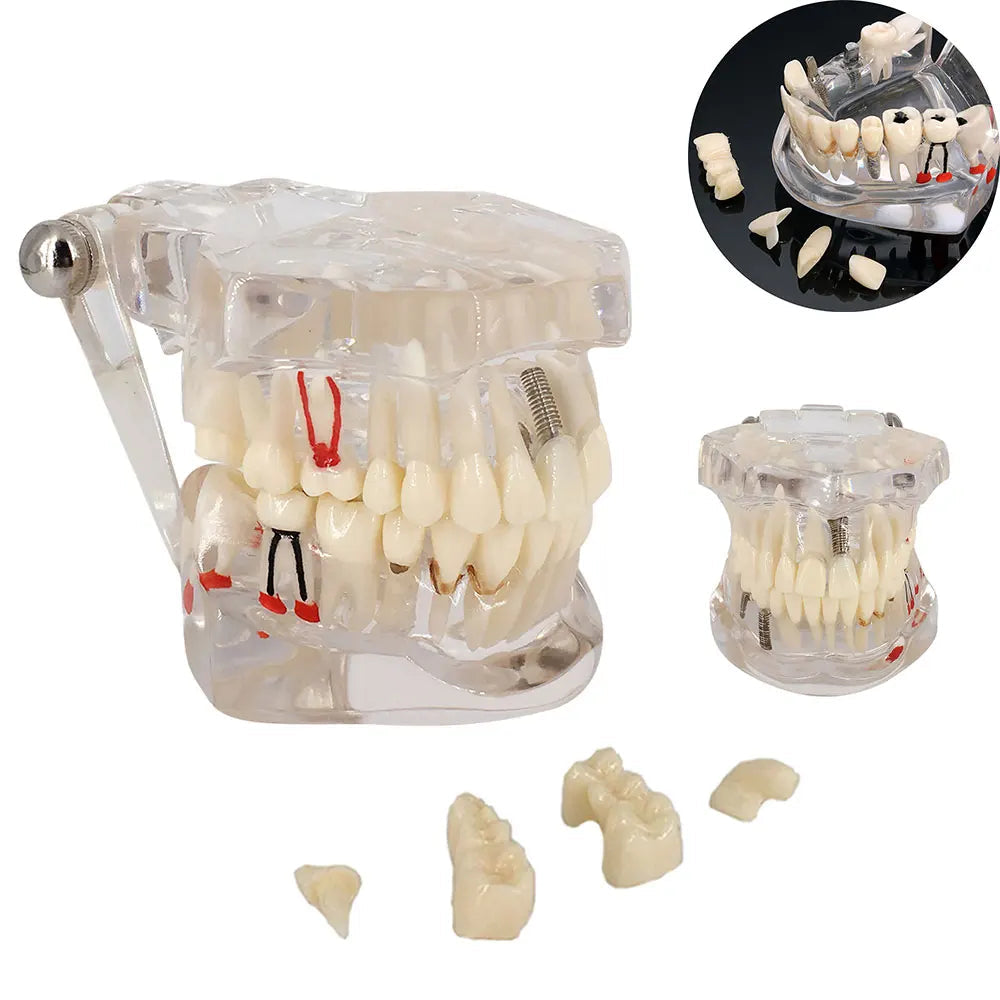 4D Human Teeth Model Dental Transparent Disease Removable Teeth Model With Restoration Bridge for Dentist Student Practice Teaching Study Medical