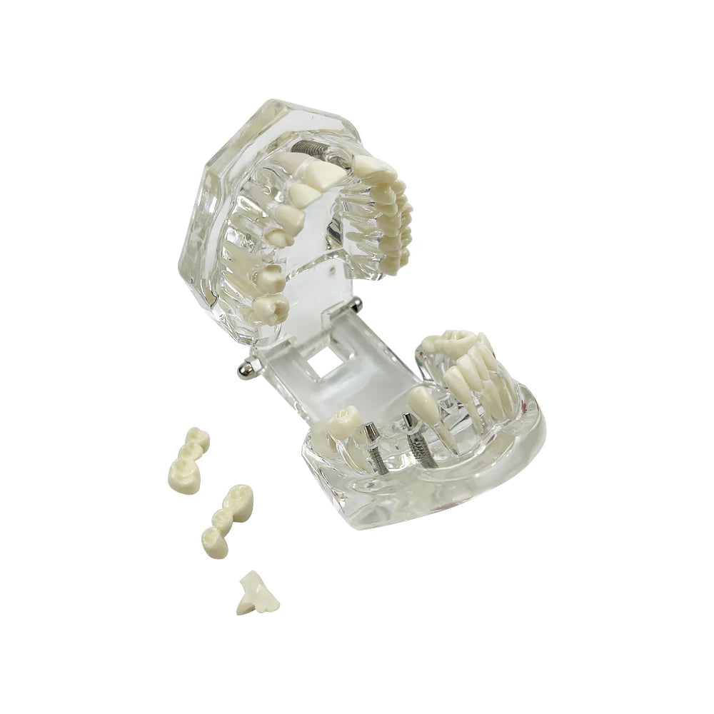 4D Human Teeth Model Dental Transparent Disease Removable Teeth Model With Restoration Bridge for Dentist Student Practice Teaching Study Medical