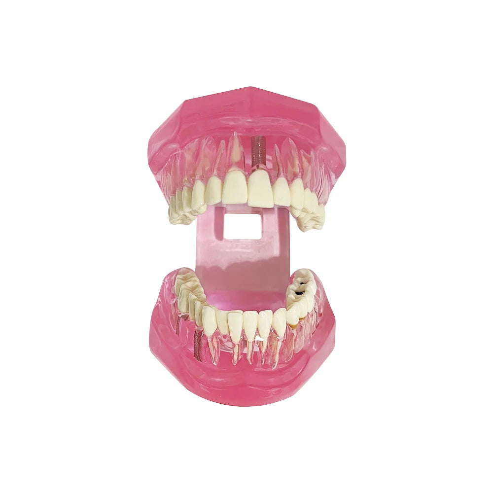 4D Human Teeth Model Dental Transparent Disease Removable Teeth Model With Restoration Bridge for Dentist Student Practice Teaching Study Medical
