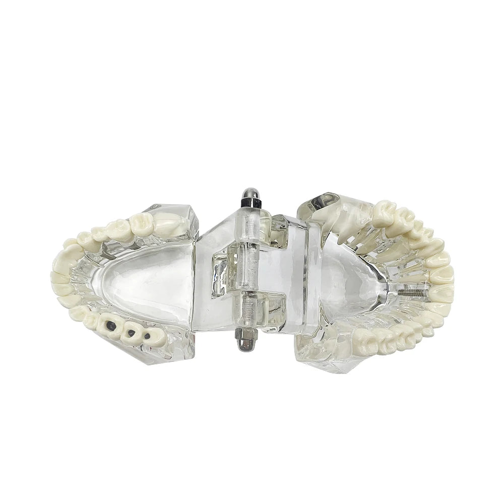 4D Human Teeth Model Dental Transparent Disease Typodont Implant With Removable Tooth Restoration Bridge Teaching Research