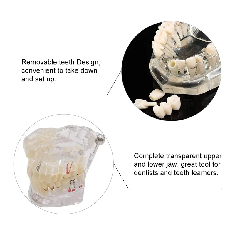4D Human Teeth Model  Dental Diseases Tooth Model Repairable Resin Models Of Diseased Teeth For Teaching And Research