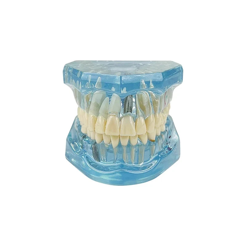 4D Human Teeth Model  Dental Diseases Tooth Model Repairable Resin Models Of Diseased Teeth For Teaching And Research