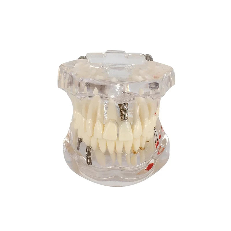 4D Human Teeth Model  Dental Diseases Tooth Model Repairable Resin Models Of Diseased Teeth For Teaching And Research