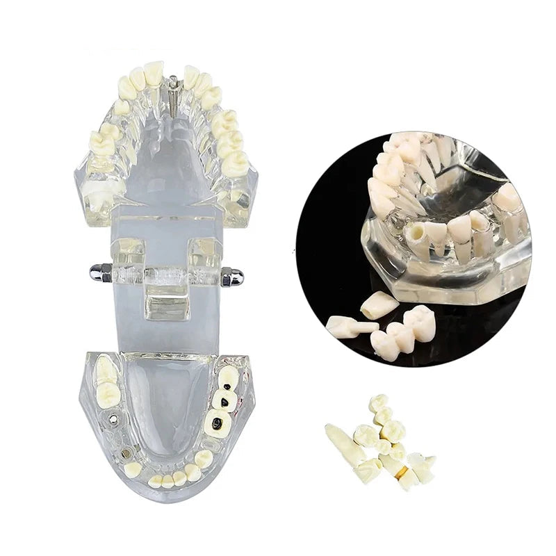 4D Human Teeth Model  Dental Diseases Tooth Model Repairable Resin Models Of Diseased Teeth For Teaching And Research
