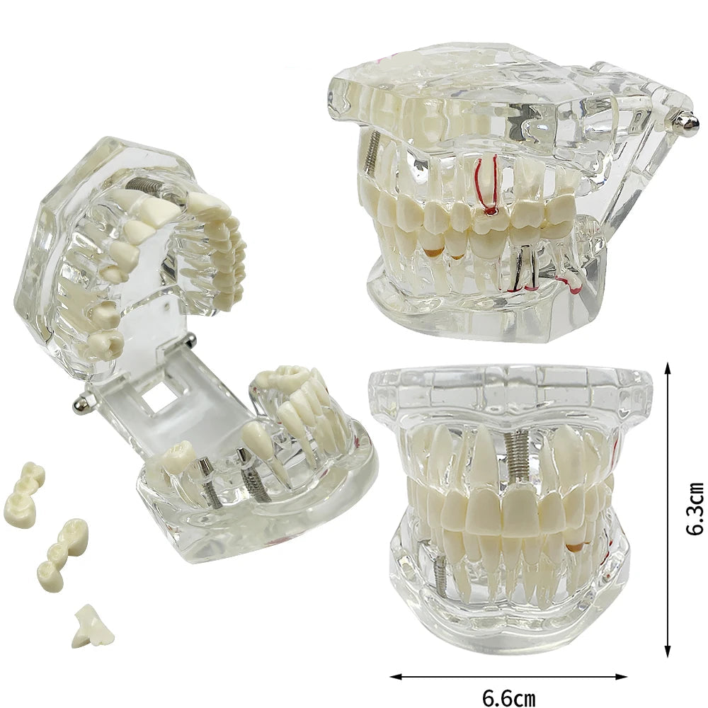 4D Human Teeth Model Dental Transparent Disease Typodont Implant With Removable Tooth Restoration Bridge Teaching Research