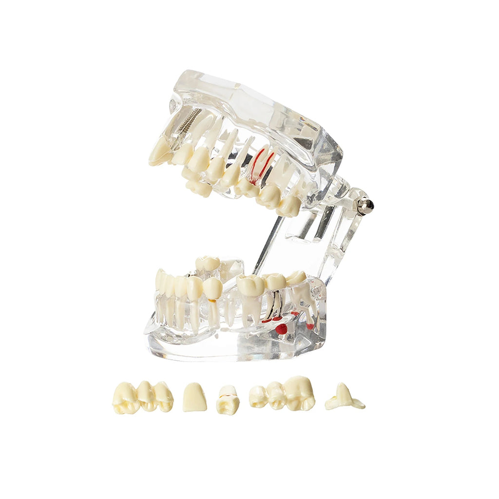 4D Human Teeth Model Dental laboratory Implant Disease Repairable Resin Models Dentist Dental Student Learning Teaching Research Communication