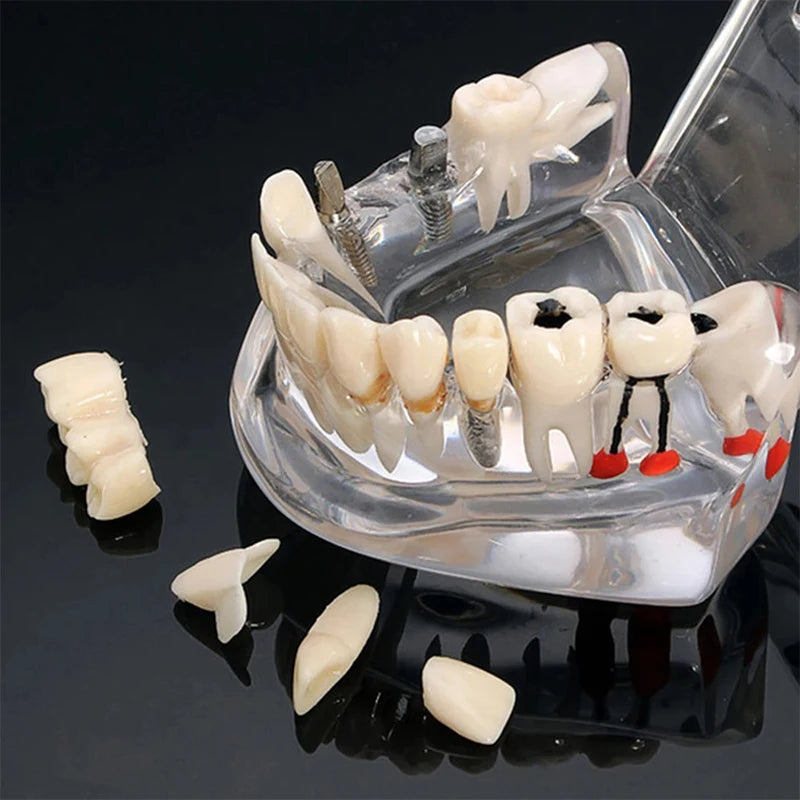 4D Human Teeth Model  Dental Diseases Tooth Model Repairable Resin Models Of Diseased Teeth For Teaching And Research