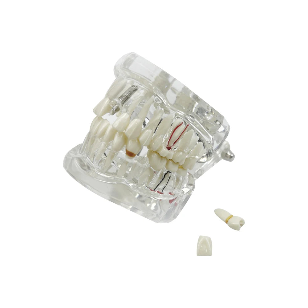 4D Human Teeth Model Dental Transparent Disease Typodont Implant With Removable Tooth Restoration Bridge Teaching Research