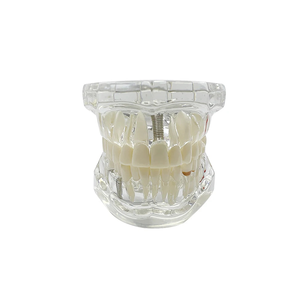 4D Human Teeth Model Dental Transparent Disease Removable Teeth Model With Restoration Bridge for Dentist Student Practice Teaching Study Medical