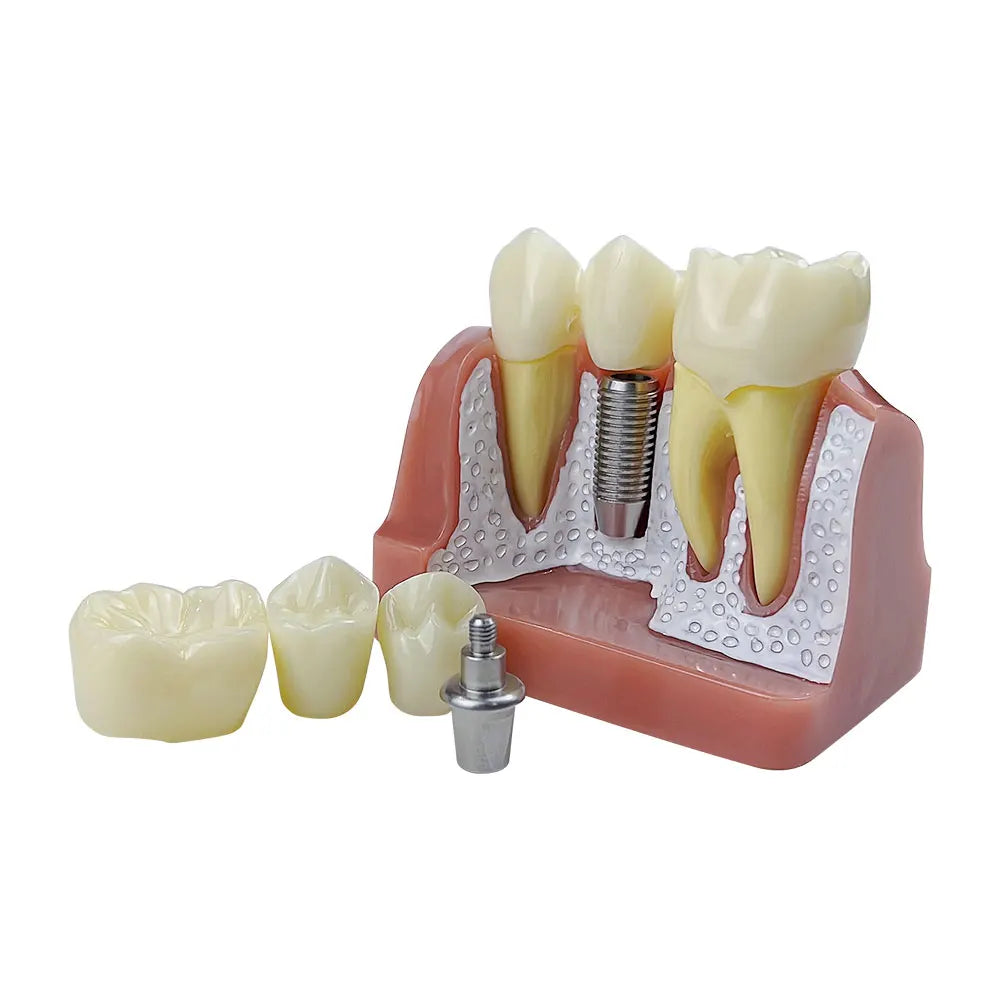 4D Human Teeth Model Decorative Analysis Model Crown Bridge Demonstration Teaching Model, Removable Training Study, 4 Times