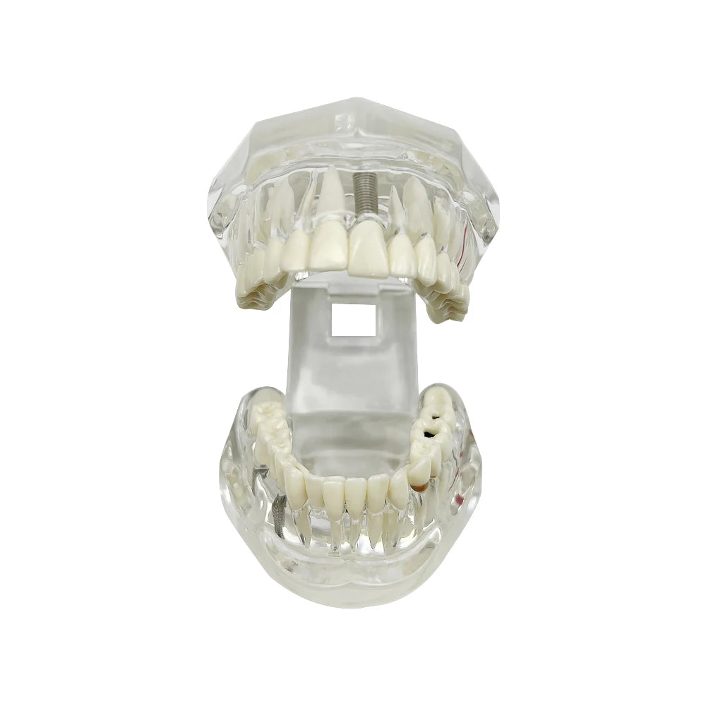 4D Human Teeth Model Dental Transparent Disease Typodont Implant With Removable Tooth Restoration Bridge Teaching Research