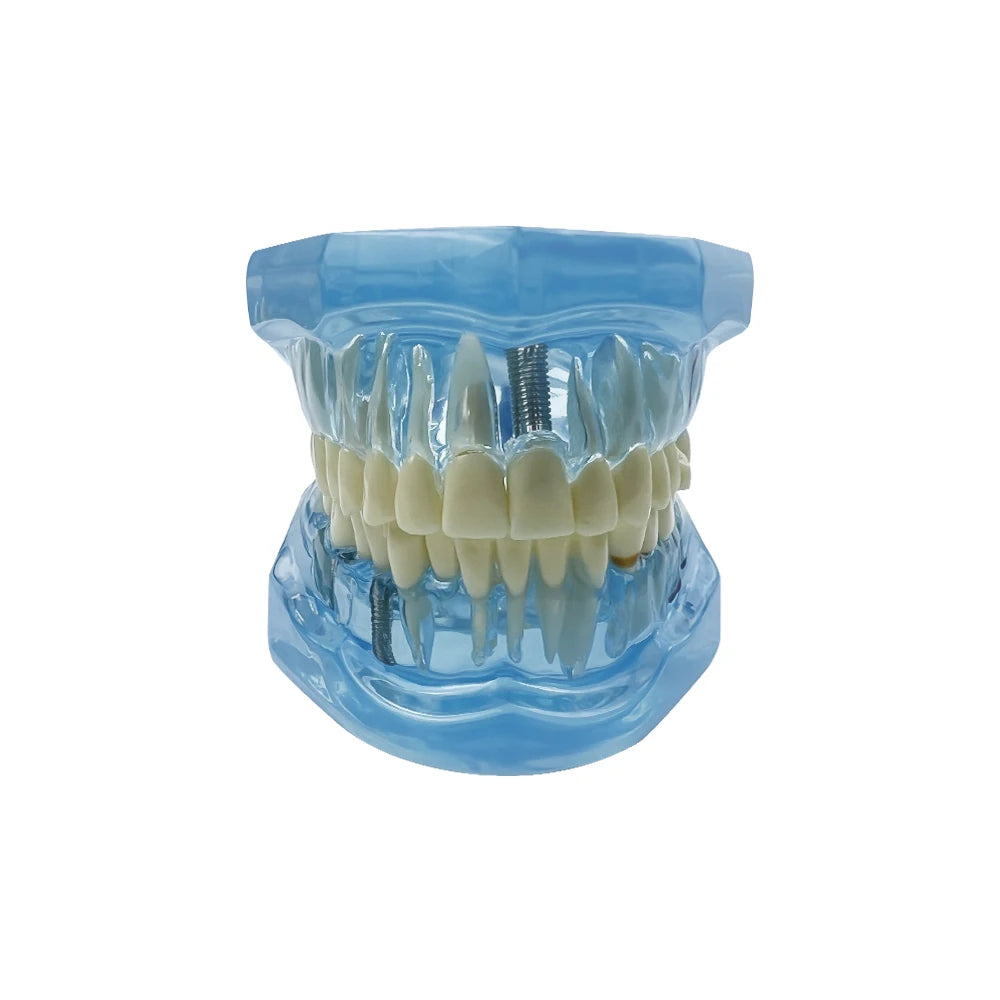 4D Human Teeth Model Dental Transparent Disease Removable Teeth Model With Restoration Bridge for Dentist Student Practice Teaching Study Medical