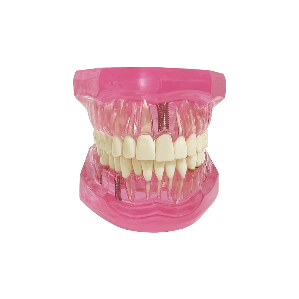 4D Human Teeth Model Dental Transparent Disease Removable Teeth Model With Restoration Bridge for Dentist Student Practice Teaching Study Medical