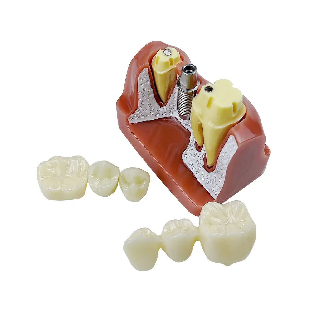4D Human Teeth Model Decorative Analysis Model Crown Bridge Demonstration Teaching Model, Removable Training Study, 4 Times