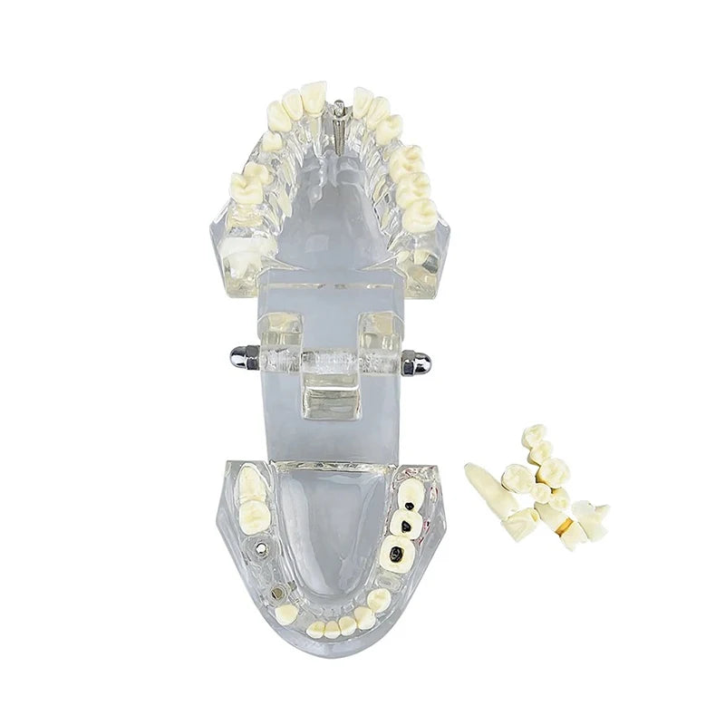 4D Human Teeth Model  Dental Diseases Tooth Model Repairable Resin Models Of Diseased Teeth For Teaching And Research