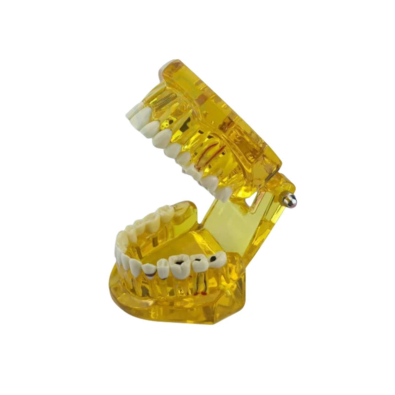 4D Human Teeth Model  Dental Diseases Tooth Model Repairable Resin Models Of Diseased Teeth For Teaching And Research