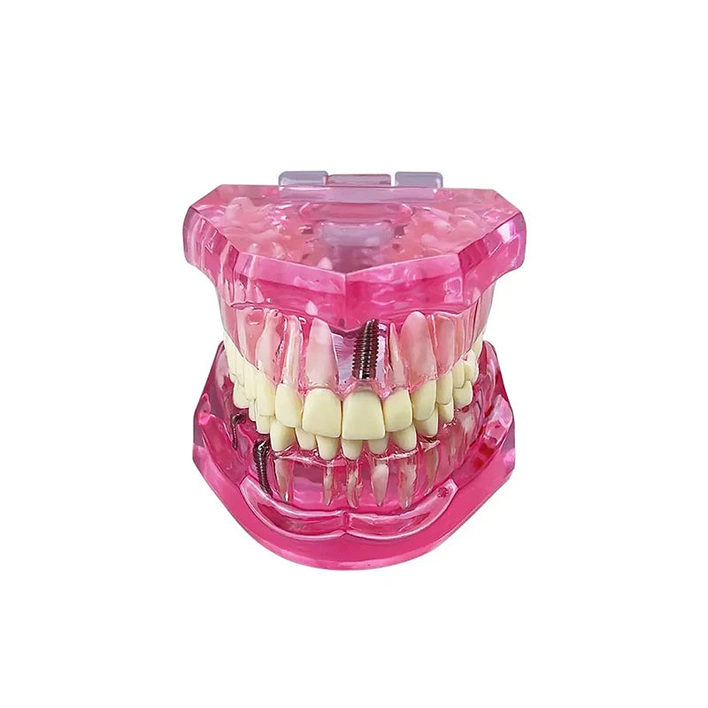 4D Human Teeth Model  Dental Diseases Tooth Model Repairable Resin Models Of Diseased Teeth For Teaching And Research