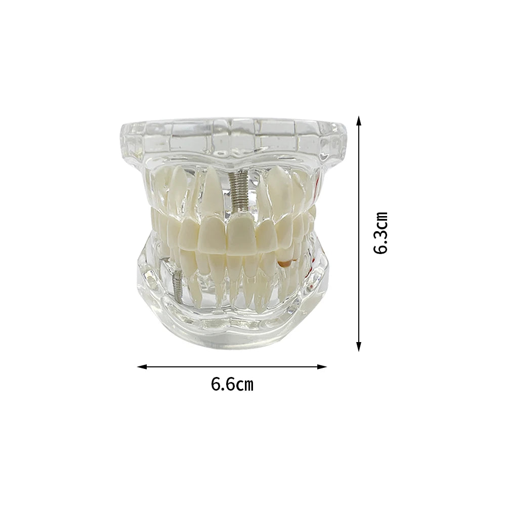 4D Human Teeth Model Dental Transparent Disease Typodont Implant With Removable Tooth Restoration Bridge Teaching Research